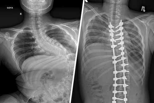 Врачи НИИТО помогли 12-летнему мальчику из Тувы с искривлением позвоночника