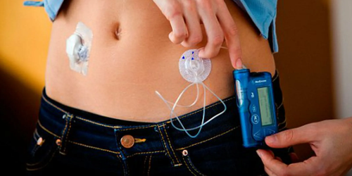 Для больных с диабетом стал доступен метод лечения с использованием инсулиновой помпы