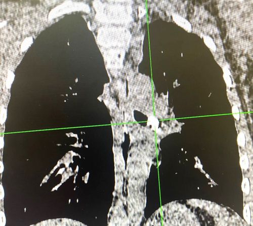 В Туве экстренная бронхоскопия спасла жизнь 9-летнему ребенку