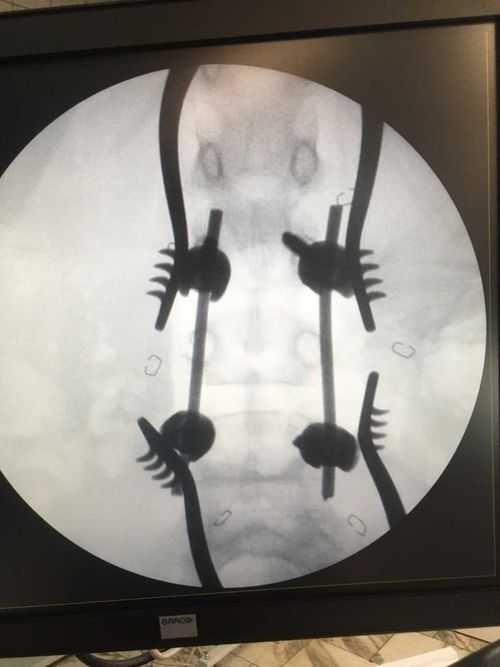 Спасли ребенка. В Туве провели сложнейшую операцию на позвоночнике